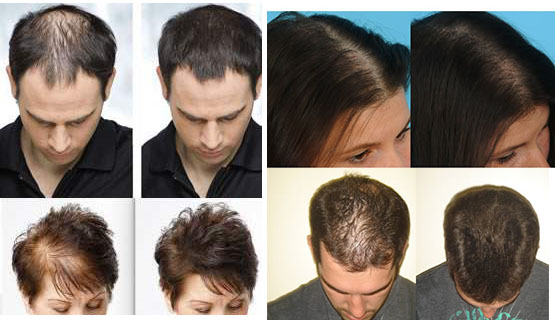 are there natural ways to regrow hair